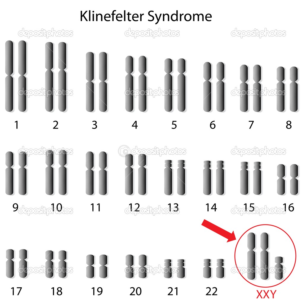 Klinefelters Syndrome